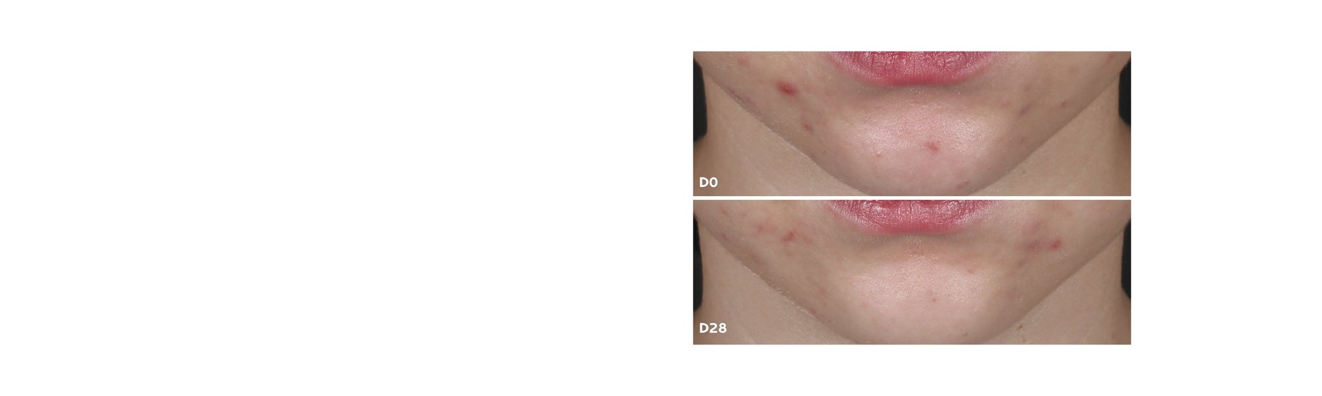 acne 1
